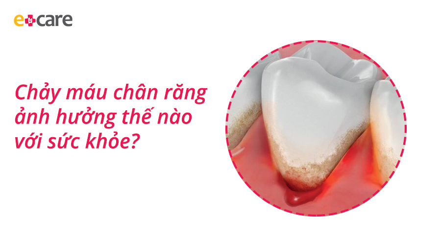 Chảy máu chân răng ảnh hưởng thế nào với sức khỏe?