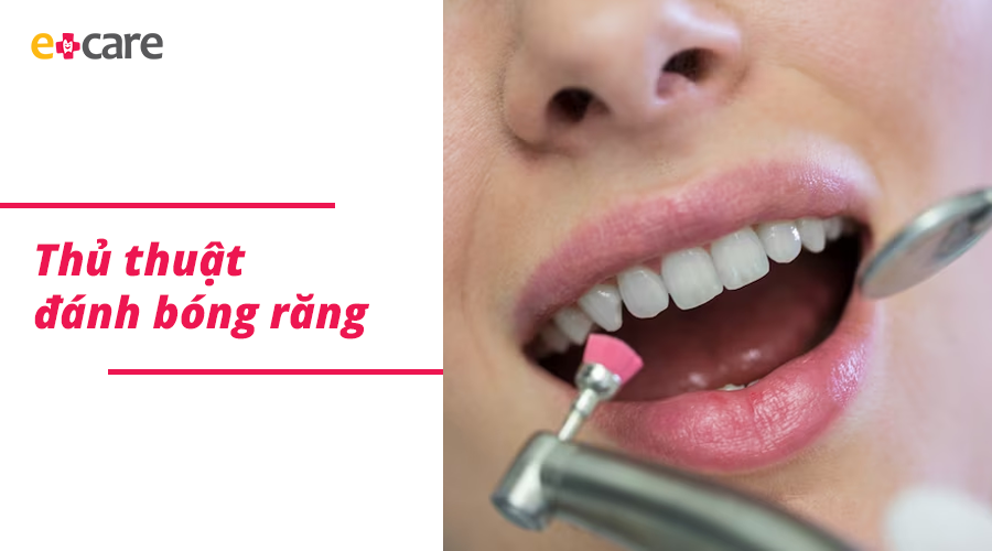 Những điều cần biết về thủ thuật đánh bóng răng