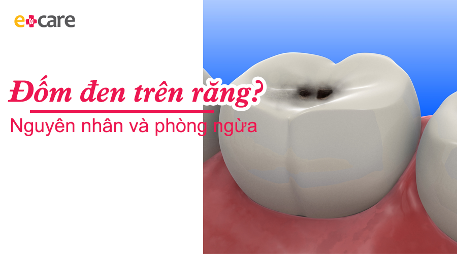 Răng xuất hiện các đốm đen: nguyên nhân do đâu?