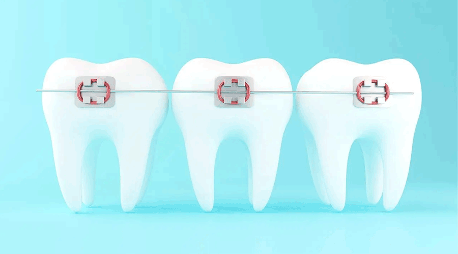 Những dòng kem đánh răng dành cho răng niềng