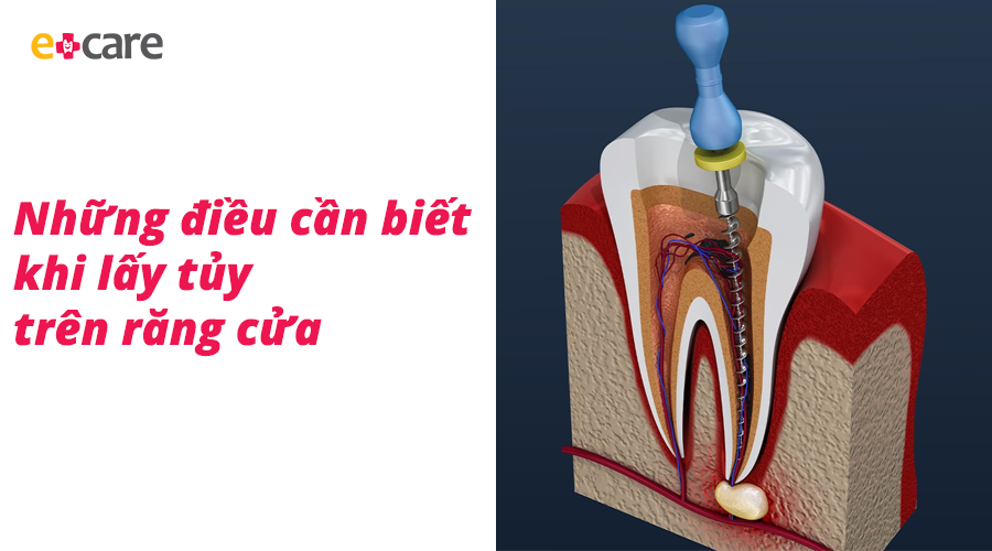 Những điều cần biết khi lấy tủy trên răng cửa