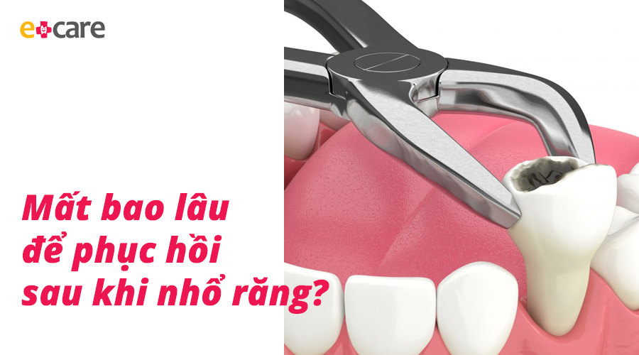 Mất bao lâu để phục hồi sau khi nhổ răng?