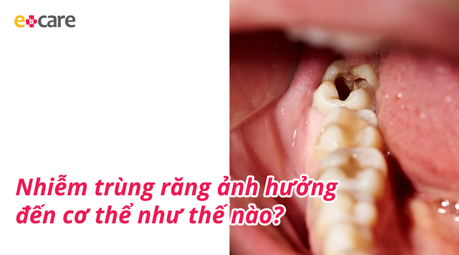 Nhiễm trùng răng ảnh hưởng đến cơ thể như thế nào?