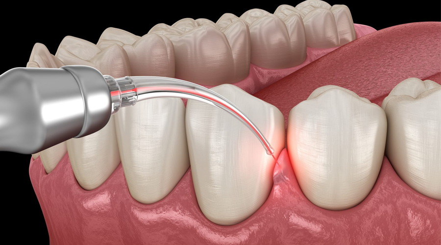 Những điều cần biết về phẫu thuật nướu răng bằng Laser