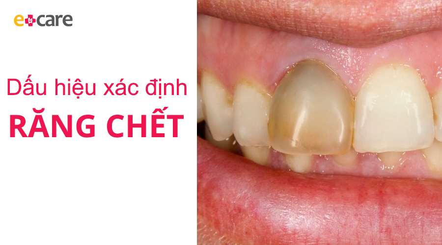 Dấu hiệu xác định răng chết