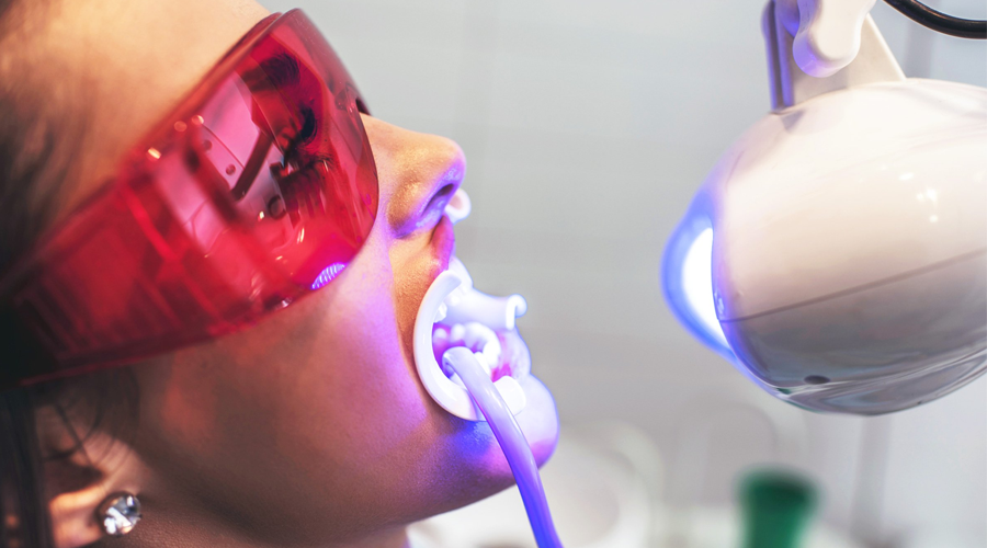 Tẩy trắng răng tại phòng nha: cần biết những gì?
