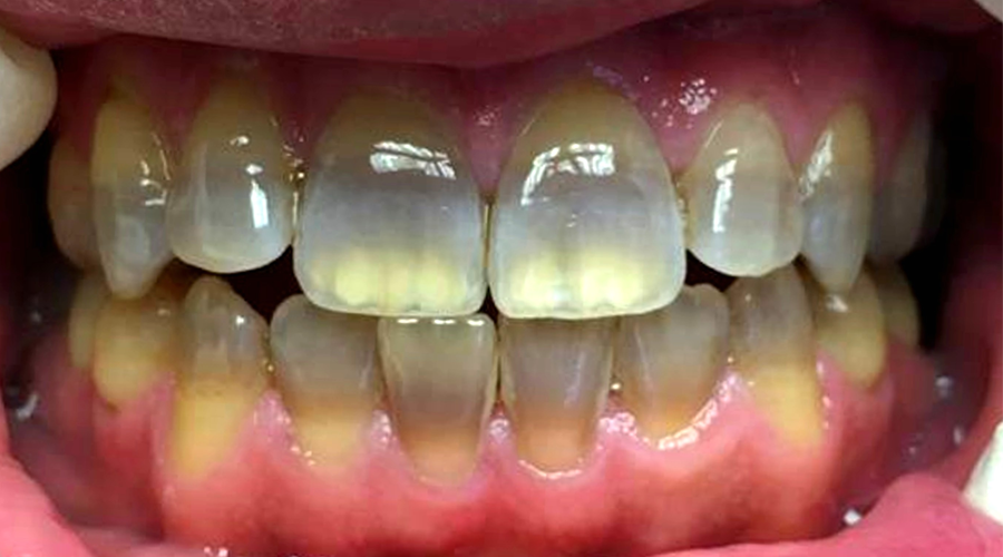 Tetracycline ảnh hưởng đến răng như thế nào?