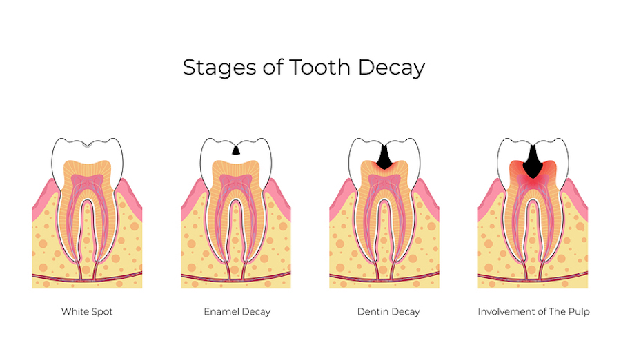 5 dấu hiệu cho thấy bạn đang bị sâu răng