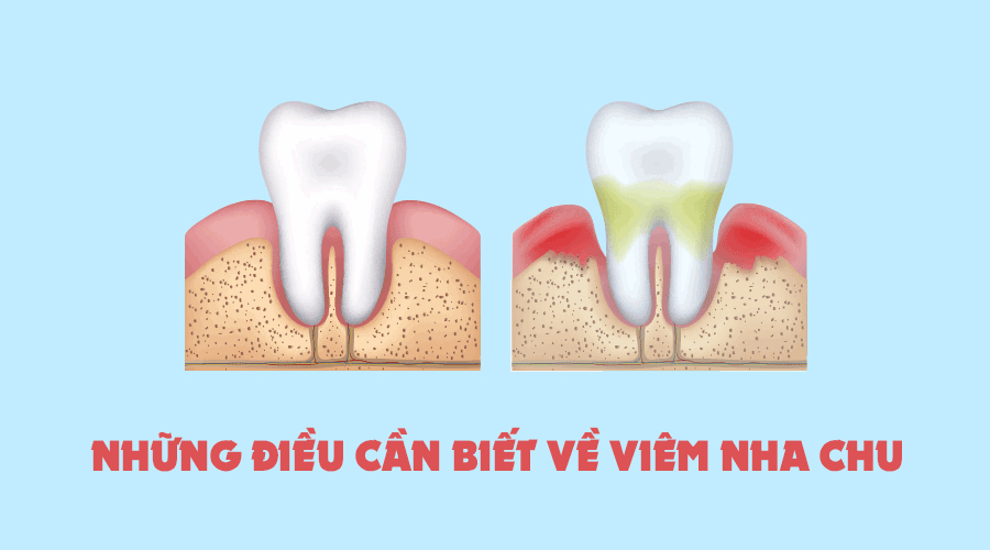 Cần biết gì về bệnh viêm nha chu?