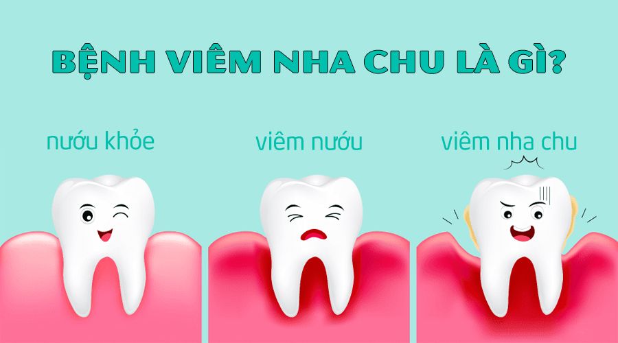 Bệnh nha chu là gì ?