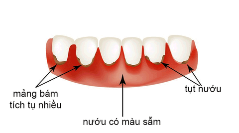 Những điều cần biết về bệnh viêm nướu | ECARE STORE