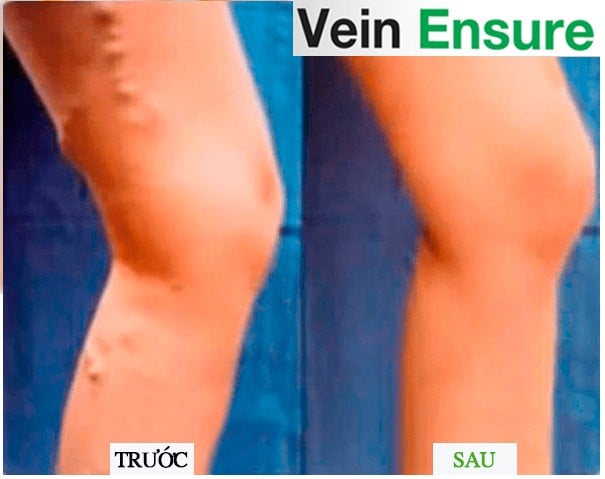 Vein ensure điều trị suy giãn tĩnh mạch