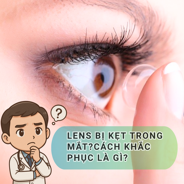 Lens Bị Kẹt Trong Mắt: Nguyên Nhân Và Cách Khắc Phục