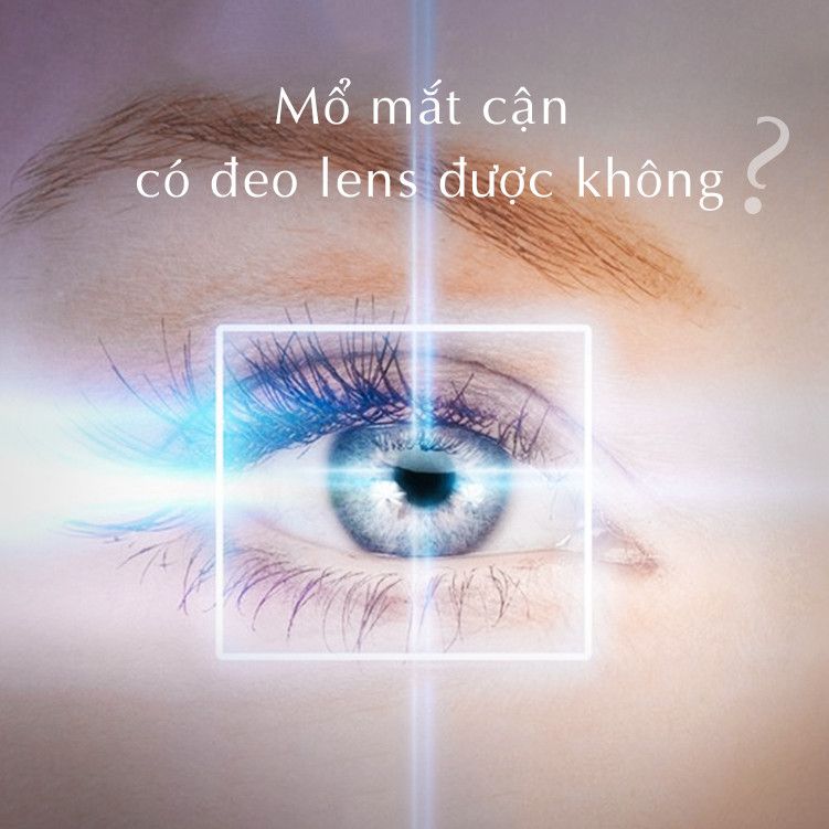 Mổ mắt cận xong có đeo lens được không?
