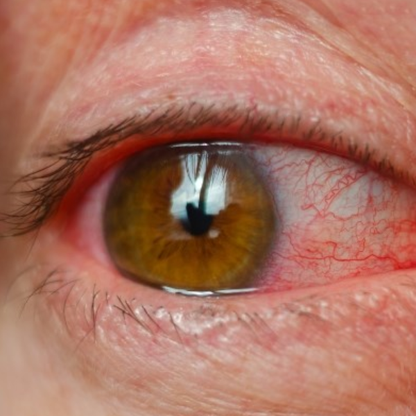 Đeo Lens Hết Hạn Có Sao Không? Cảnh Báo Nguy Hiểm Từ Thói Quen Chủ Quan