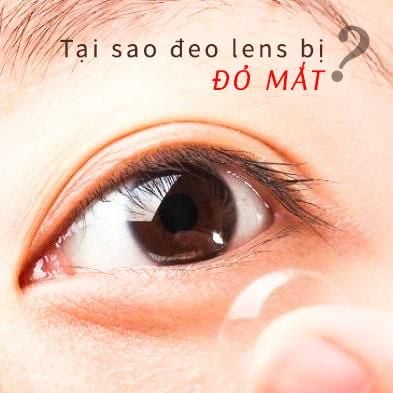 TẠI SAO ĐEO LENS BỊ CAY MẮT?