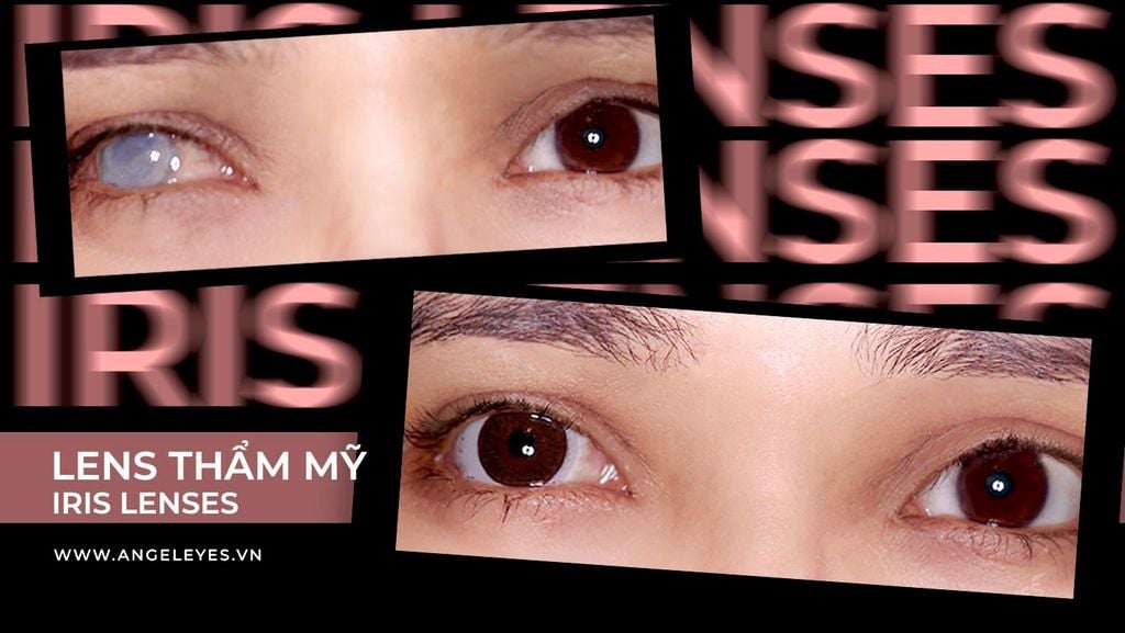 KÍNH ÁP TRÒNG THẨM MỸ | LENS CHE KHUYẾT ĐIỂM | IRIS CONTACT LENSES
