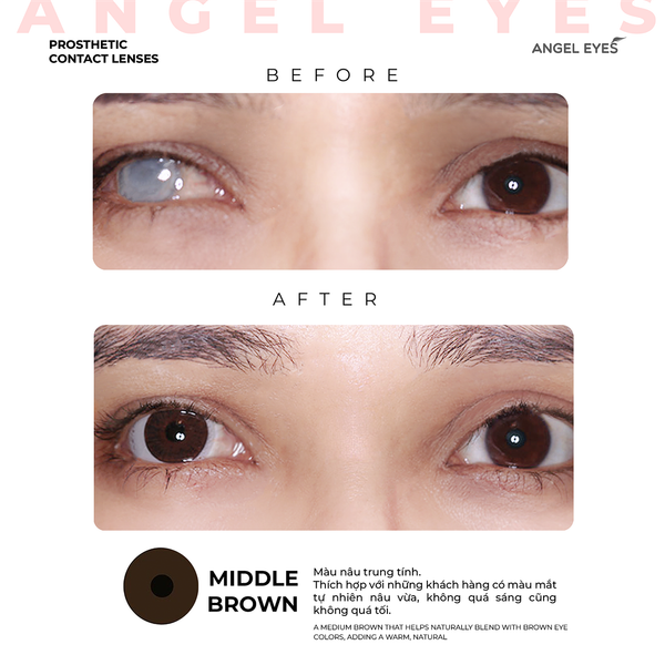 Contact lens thẩm mỹ