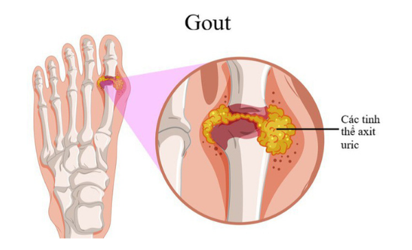 điều trị gout Anserine Minami