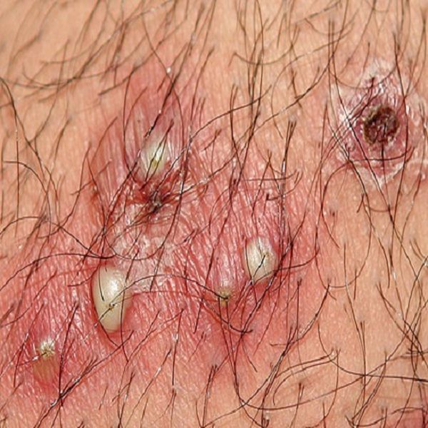 Biến chứng nguy hiểm từ viêm lỗ chân lông