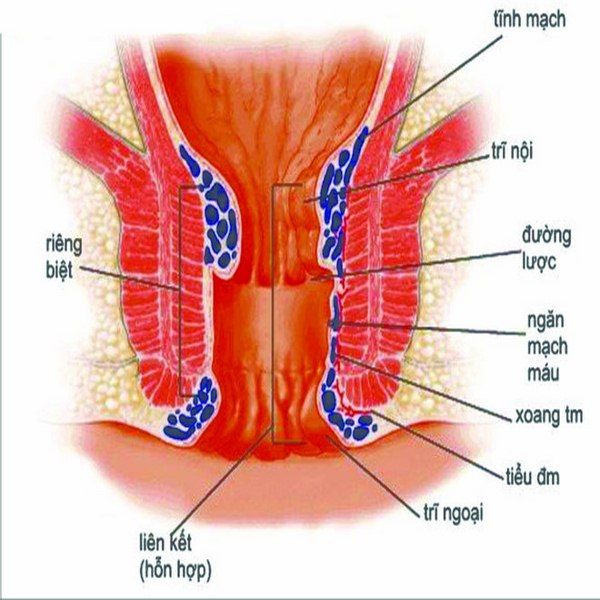 Điều trị bệnh trĩ mà không cần đến phẫu thuật