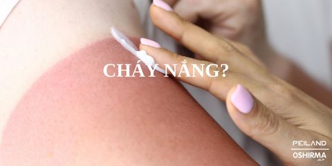 MẸO TẠM BIỆT LÀN DA CHÁY NẮNG