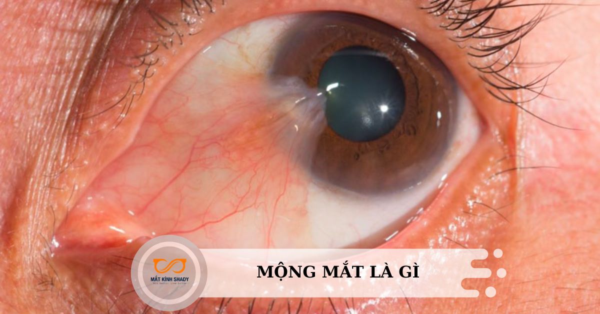 Mộng mắt (Mộng thịt) là gì? Bị mộng thịt ở mắt phải làm sao