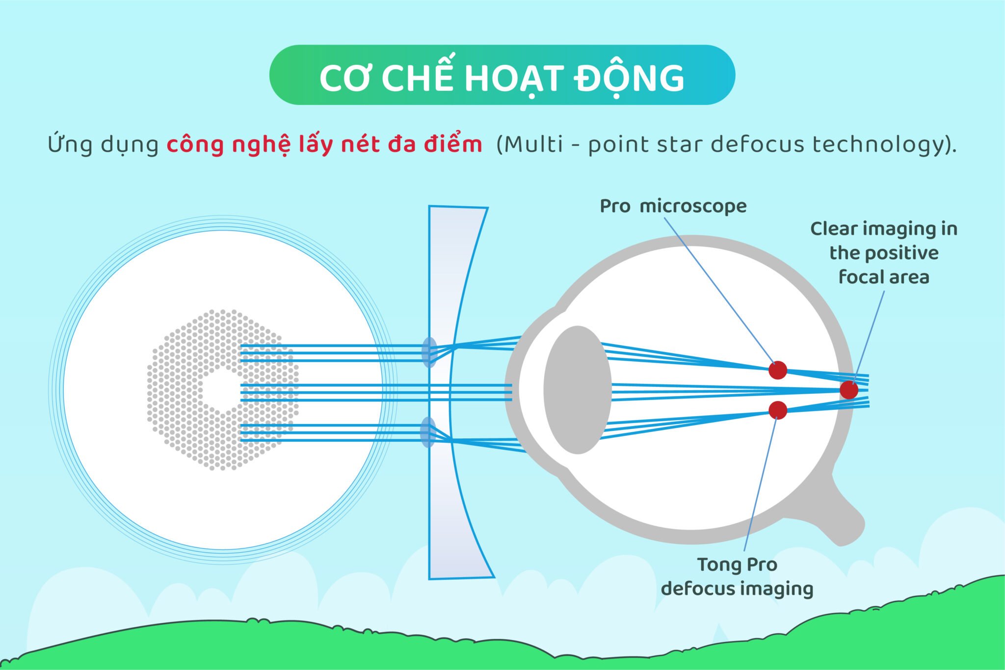 Tròng Kính Kiểm Soát Tiến Triển Cận Thị Trẻ Em Defocus Smart Lens