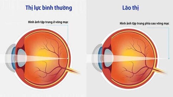 Kính Lão Là Thấu Kính Gì? Cách Chọn Và Sử Dụng Hiệu Quả