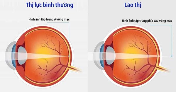 So Sánh Mắt Viễn Thị Và Lão Thị Khác Nhau Như Thế Nào Và Cách Điều Trị 