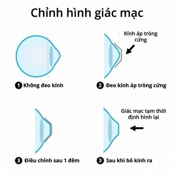 Quy Trình Kiểm Tra Thị Lực