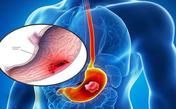 Ung thư dạ dày có thể được điều trị hoặc hỗ trợ bằng yến sào không?