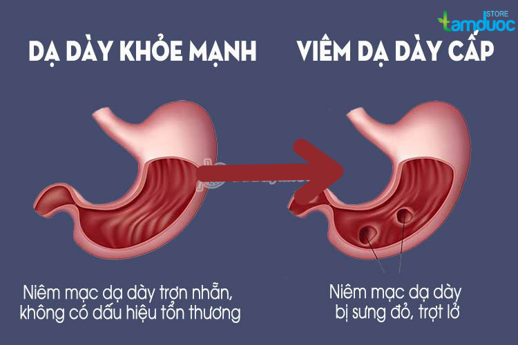 Người Bị Viêm Loét Dạ Dày Bao Lâu Thì Khỏi?