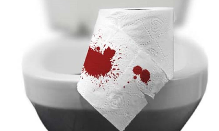 BỆNH TRĨ XUẤT HUYẾT VÀ CÁCH ĐIỀU TRỊ