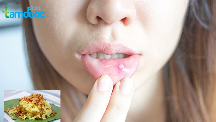 Bị Nhiệt Miệng Ăn Xôi Được Không?