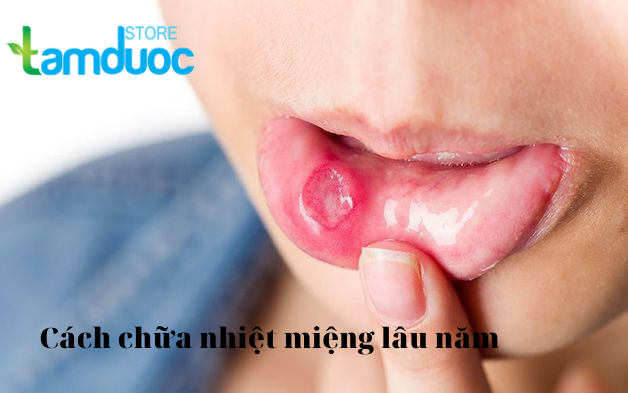Hướng Dẫn Chữa Nhiệt Miệng Lâu Năm Không Khỏi