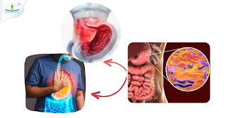 Cao chè dây: Tăng cường tiêu hóa và cải thiện viêm loét dạ dày ở người hay dùng thuốc tây và tăng axit dạ dày