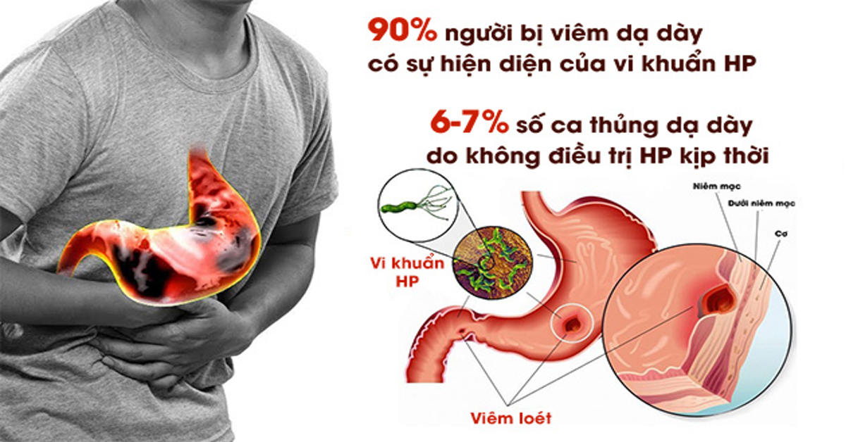 Bệnh Đau Dạ Dày Có Bị Lây Không?