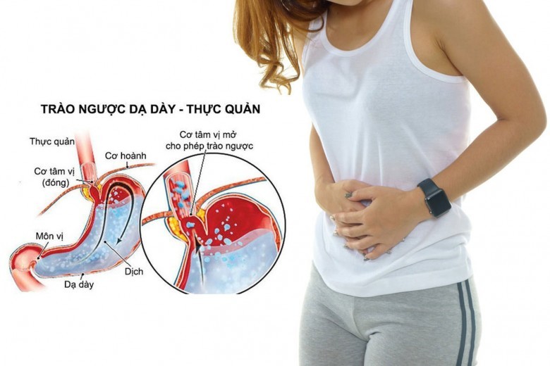 Hậu Quả Của Trào Ngược Dạ Dày Thực Quản