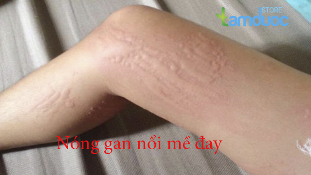 Nóng Gan Nổi Mề Đay Và Hướng Điều Trị