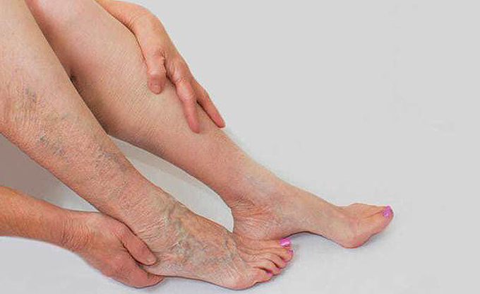 BỆNH SUY GIÃN TĨNH MẠCH CHÂN CÓ CHỮA ĐƯỢC KHÔNG?