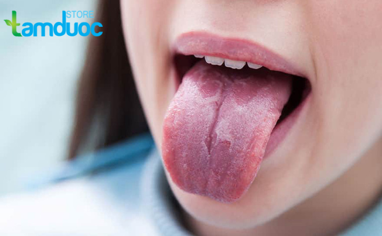 Trào Ngược Dạ Dày Thực Quản Gây Rát Lưỡi