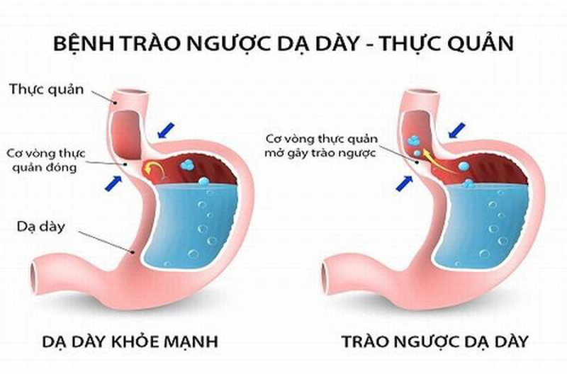 Trào Ngược Dạ Dày Thực Quản Là Gì?