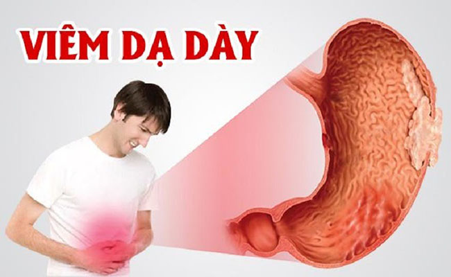 Viêm Loét Dạ Dày Có Mấy Cấp Độ?