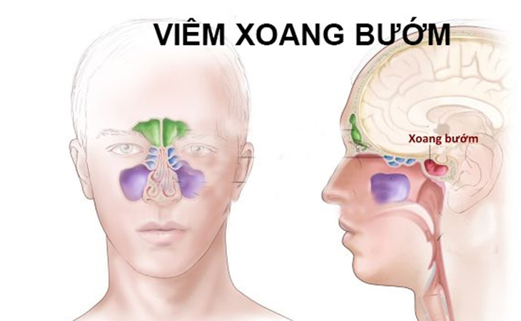 Viêm Xoang Bướm Có Nguy Hiểm Không?