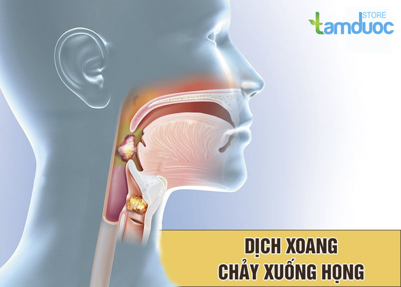 Viêm Xoang Dịch Chảy Xuống Họng Và Cách Điều Trị Hiệu Quả