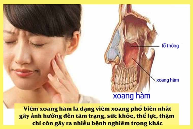 Bệnh Viêm Xoang Hàm Và Cách Điều Trị Hiệu Quả