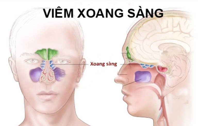 Viêm Xoang Sàng Sau Có Chữa Được Không?