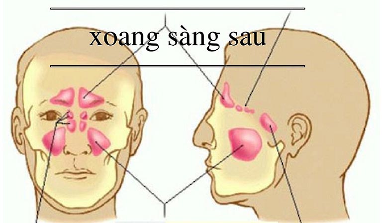 Bệnh Viêm Xoang Sàng Và Cách Điều Trị