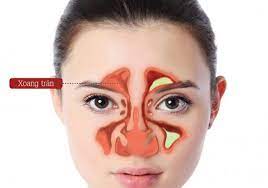 Viêm Xoang Trán Là Gì?